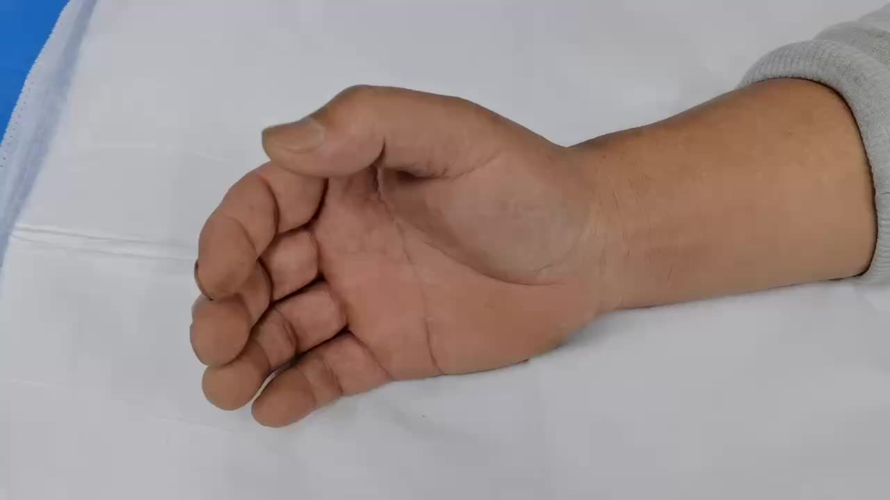 腱鞘炎治疗有妙招——可视化针刀技术